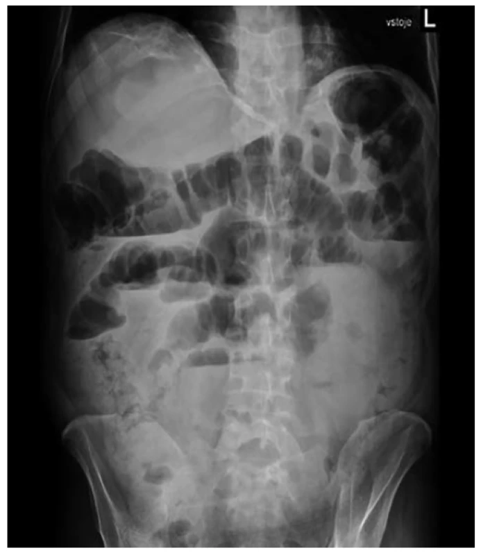 RTG břicha – v den přijetí<br>
Fig. 1: Abdominal X-ray – on the day of admission