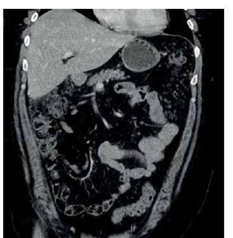 CT obraz infiltrace omenta, patrná hlavně subhepatálně
a v levém parakolickém prostoru.<br>
Fig. 1: CT image of infiltration of the omentum, visible in
the subhepatal area and left paracolic area.