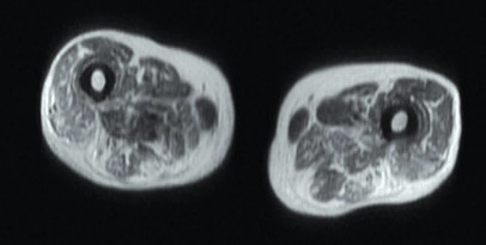 Axiální T1 vážená sekvence – tuková přestavba a svalová atrofie u pacienta s imunitně zprostředkovanou nekrotizující myopatií. Zdroj: Archiv Revmatologického ústavu (ÚVN Střešovice, Discovery 450; 1,5 T)