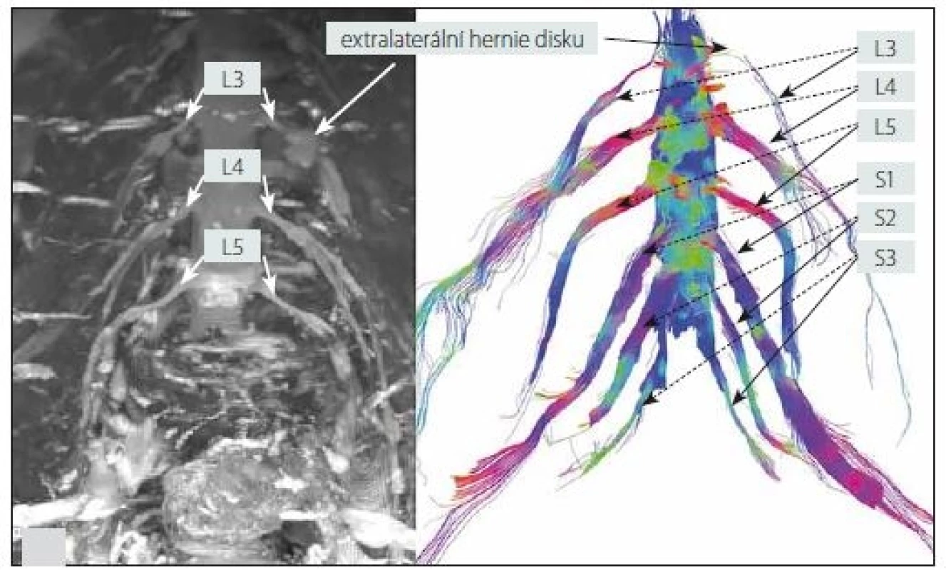3D MR neurografie (sekvence STIR-SPACE, maximum intensity projection; MIP) – levý obrázek a MR traktografie – pravý obrázek oboustranného lumbosakrálního plexu s nálezem extralaterální hernie disku L3/4 vlevo (muž, 63 let). Na pravém obrázku lze na MR traktografii pozorovat útlum signálu kořene L3 vlevo při jeho výstupu z foramina, což odpovídá lokalizaci extralaterální hernie disku.<br> Fig. 6. 3D MR neurography (STIR-SPACE sequence, maximum intensity projection; MIP) – left picture and MR tractography – right picture of the bilateral lumbosacral plexi with left L3/4 extralateral disc herniation (male, 63 years). In the right picture, left L3 root signal attenuation can be observed on MR tractography at its exit from the foramen, which corresponds to the localization of the extralateral disc herniation.