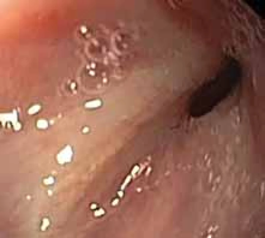 Conic shape of the fistula in fibrous tissue. Risk factor for clipping
failure.
Obr. 4. Píštěl konického tvaru ve vazivovém terénu. Rizikový faktor pro selhání klipování.