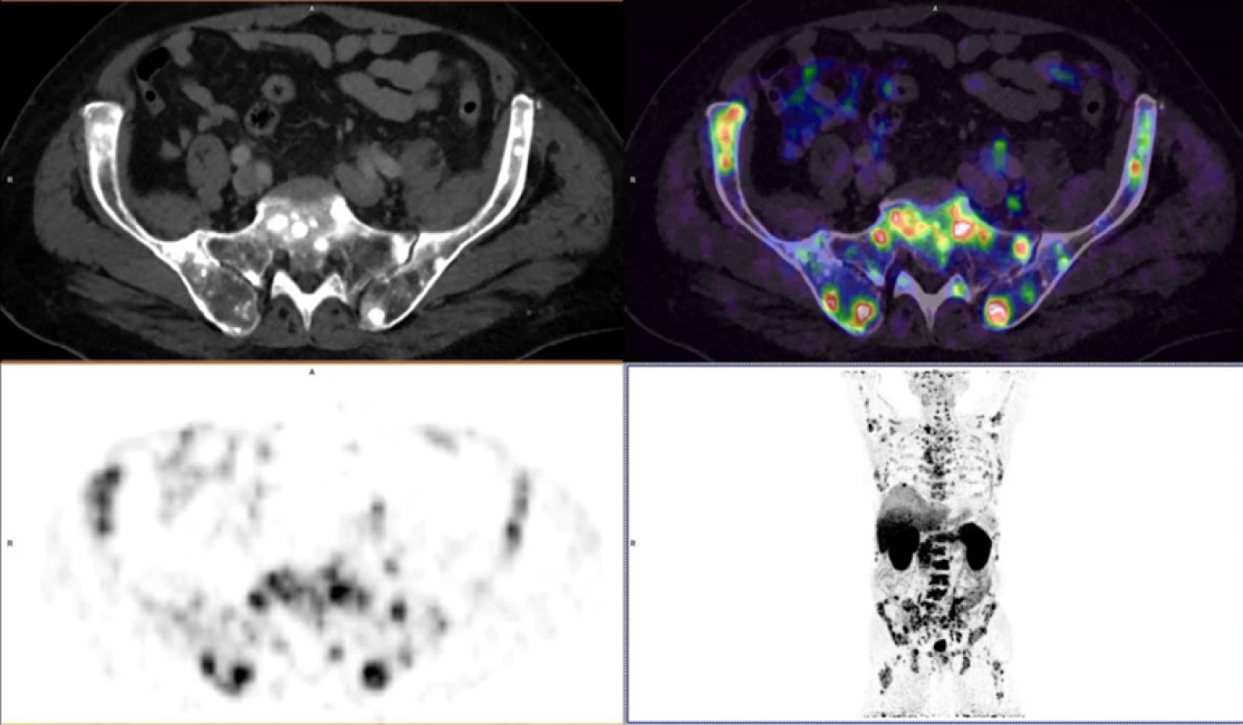 Vícečetné kostní metastázy u karcinomu prostaty<br>
Fig. 5. Multiple bones metastases in prostate cancer 