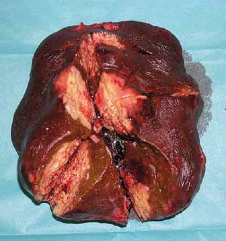 Resekát.<br>
Fig. 5. Resectate.
