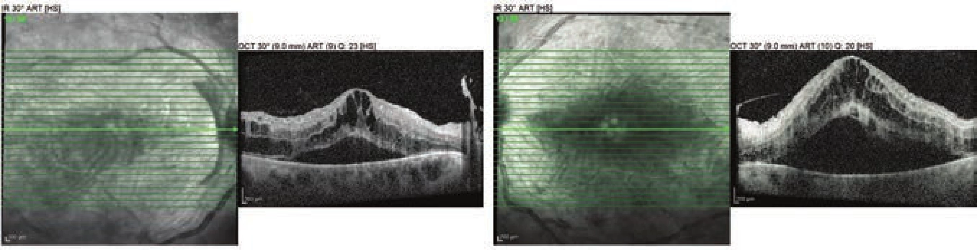 OCT examination of both eyes in 23rd week of second pregnancy
