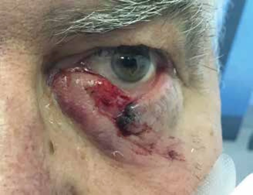 Lacerated injury to lower eyelid caused by small dog, without injury of canaliculus