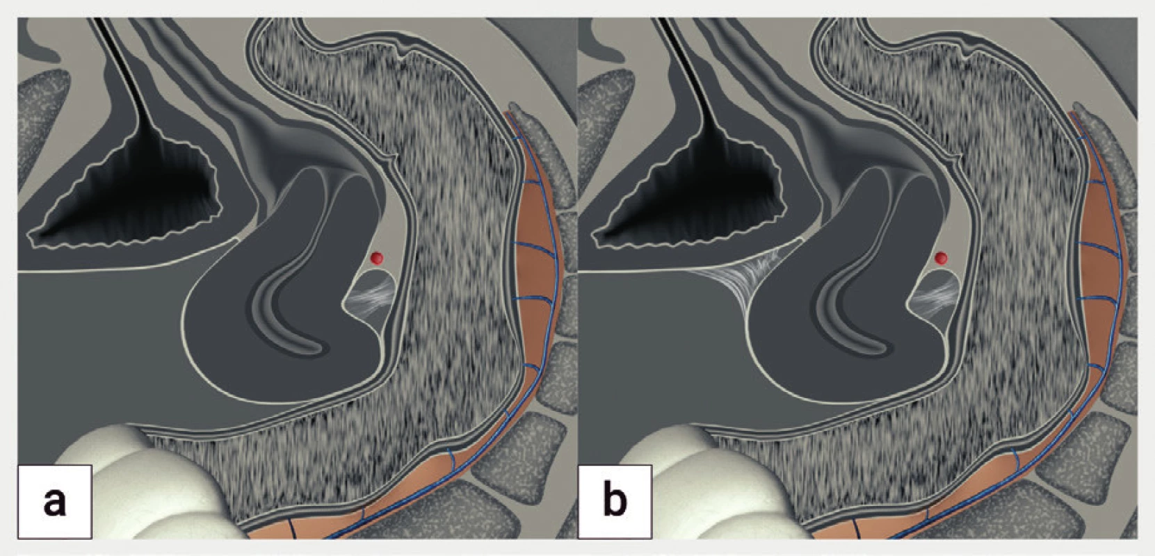 Schéma obliterace pánve (frozen pelvis)<br>
Děloha je deformována na podkladě srůstů v Douglasově prostoru do
tvaru ‚otazníku'. Při lehkém tlaku sondou proti děložnímu hrdlu není
možné zobrazit posunlivost dělohy proti rektu (negative sliding sign)
na podkladě srůstů, proti močovému měchýři je děloha posunlivá
(positive sliding sign) (a), v případě adhezí v předním a zadním
kompartmentu je děloha neposunlivá proti močovému měchýři
a rektu (b).
