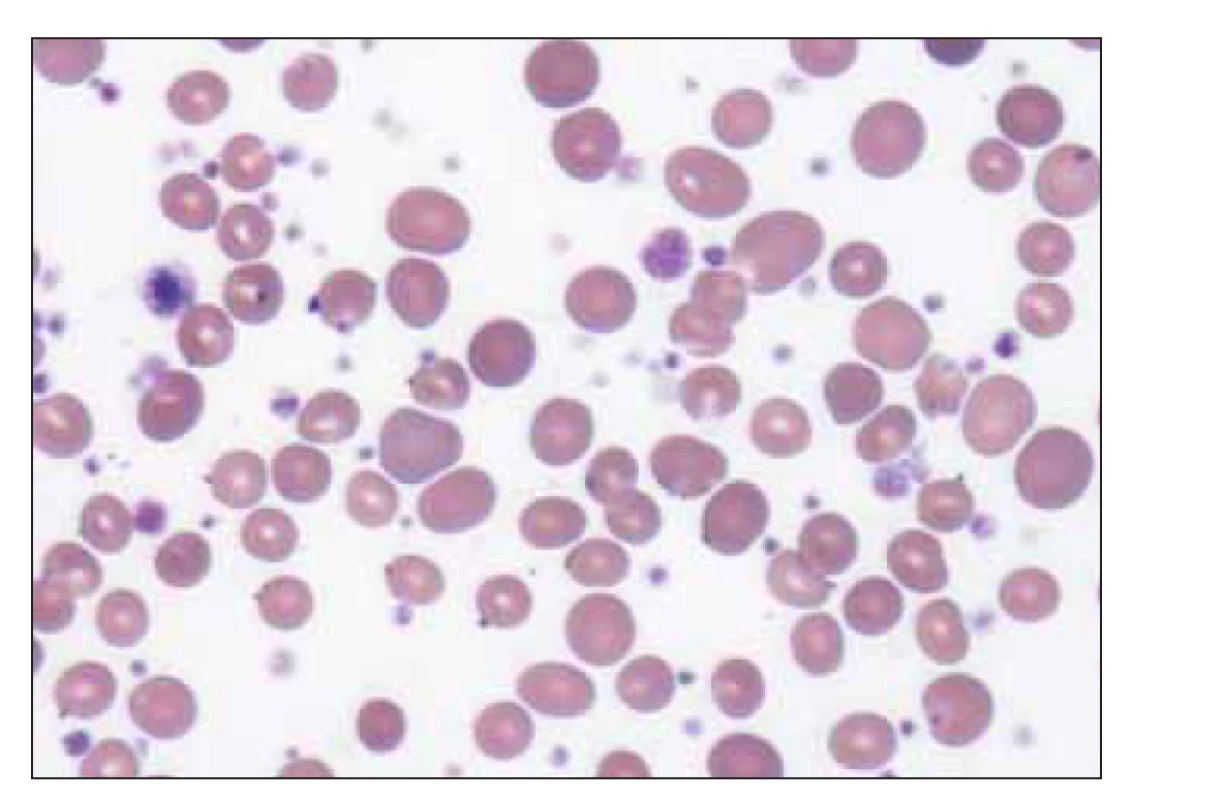 Erytrocyty a četná populace makrotrombocytů
v nátěru periferní krve u esenciální trombocytemie<br>
(zdroj: laboratoř IV. IHK).