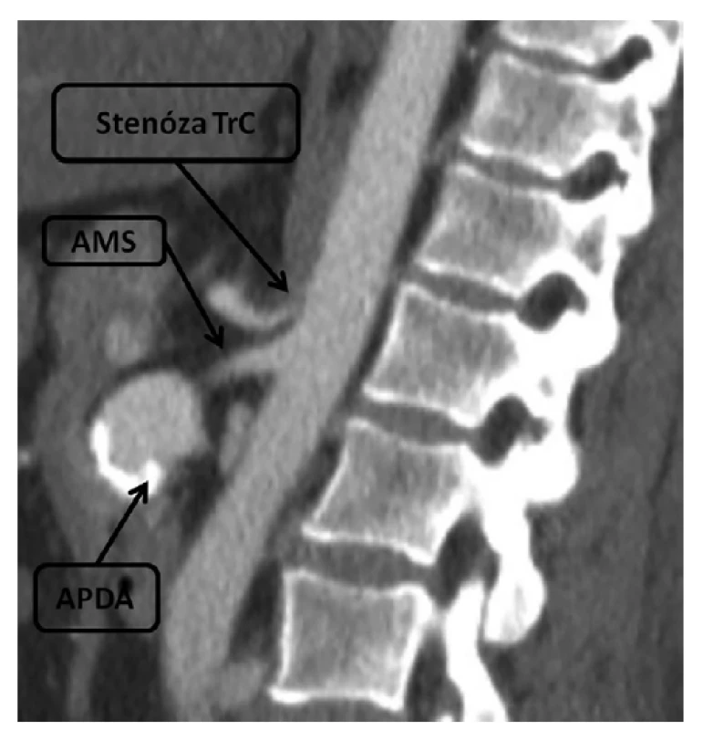 CT obraz, aneuryzma pankreatikoduodenální arkády
a stenóza odstupu truncus coeliacus<br>
Fig. 1: CT scan, pancreaticoduodenal arcade aneurysm
and stenosis of coeliac trunk origin