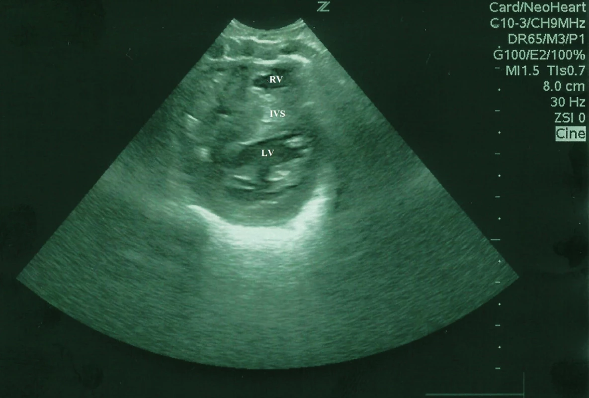 Bidimenzionálny echokardiogram, parasternálne krátka os, hypertrofická KMP u novorodenca, asymetrická hypertrofia IVS, LV<br> Fig. 2. Bidimensional echocardiogram showing short axis parasternal views of the left ventricle of a newborn, hypertrophic cardiomyopathy, asymmetrical hypertrophy of the septum and left ventricular hypertrophy.