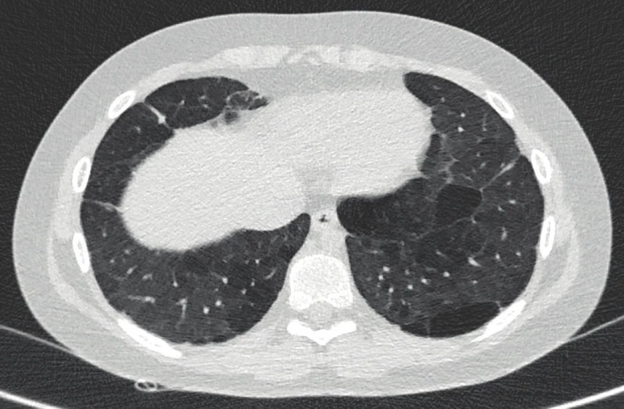 Počítačová tomografie hrudníku s vysokým rozlišením
u 11letého chlapce narozeného ve 28. gestačním týdnu
s BPD. Nález lineárních opacit subpleurálně, okrsky
air-trappingu ve všech plicních lalocích, které se na
výdechových skenech dále zvýrazňují, bulózní tenkostěnné dutiny zcela bez plicní architektury (archiv
Radiodiagnostické kliniky 1. LF UK a VFN).<br>
Fig. 5. Chest high-resolution computed tomography of an
11-year-old boy born in the 28th gestational week with
BPD. Finding of subpleural linear opacities, areas of
air-trapping in all lung lobes, which are further highlighted on expiratory scans, bullous thin-walled
cavities completely without lung architecture (archive
of the Department of Radiology, First Faculty of
Medicine, Charles University and General University
Hospital in Prague).