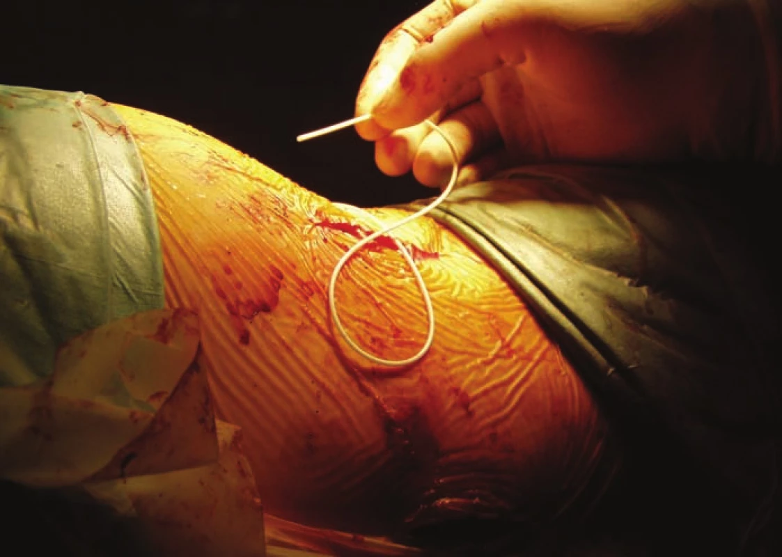 Implantácia baklofénovej pumpy – zavádzanie katétra do intratekálneho priestoru.<br>
Fig. 2. Baclofen pump implantation – catheter is inserted into the intrathecal space.