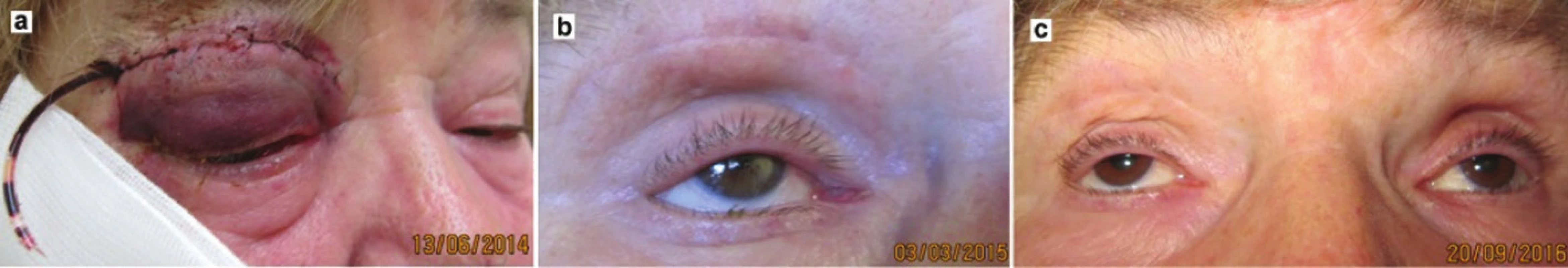 Patient after orbitotomy for lymphoma of the right orbit: a) third day after procedure, before removal of drain – 2014, b) clinical finding 9 months later – 2015, c) clinical find at follow-up examination – 2016
