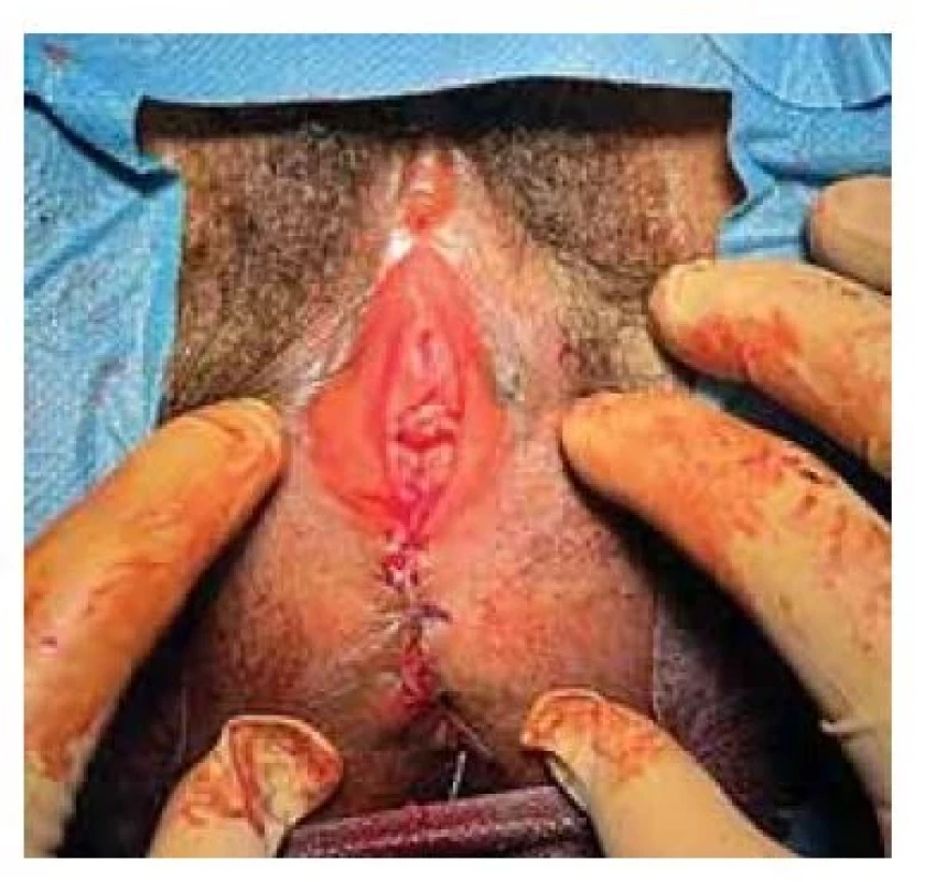 Po výkonu, publikováno se
svolením pacientky.<br>
Fig. 4. After the procedure, published
with the permission of the patient.
