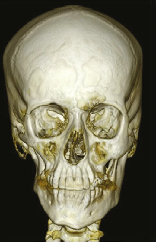 CT obličejového skeletu
pacienta s OAVS
ve věku 15 let,
pravostranné postižení
(obrazová dokumentace
oddělení ortodoncie
a rozštěpových vad,
Stomatologická klinika FNKV,
Praha)<br>
Fig. 3
CT of skull of patient
with OAVS, 15-year-old,
right side affected
(Department of Orthodontics
and Cleft Anomalies,
3rd Faculty of Medicine,
Charles University
and Kralovske Vinohrady
University Hospital)