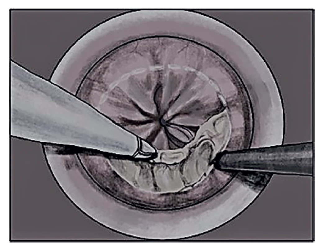 Disekce v rámci transanální mezorektální excize<br>
Fig. 5: Surgical dissection during transanal total mesorectal
excision
