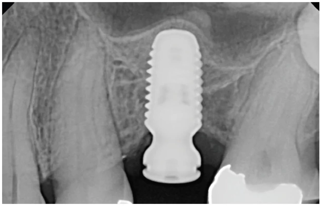 RTG snímek zhojeného
implantátu tři měsíce po
implantaci vykazující kortikaci
kraniální části augmentátu
po transalveolárním sinus
liftu <br> 
Fig. 3 Radiographic image of the
healed implant three months
post implantation, showing
cortication of the cranial
portion of the augmented area
after the transalveolar sinus lift