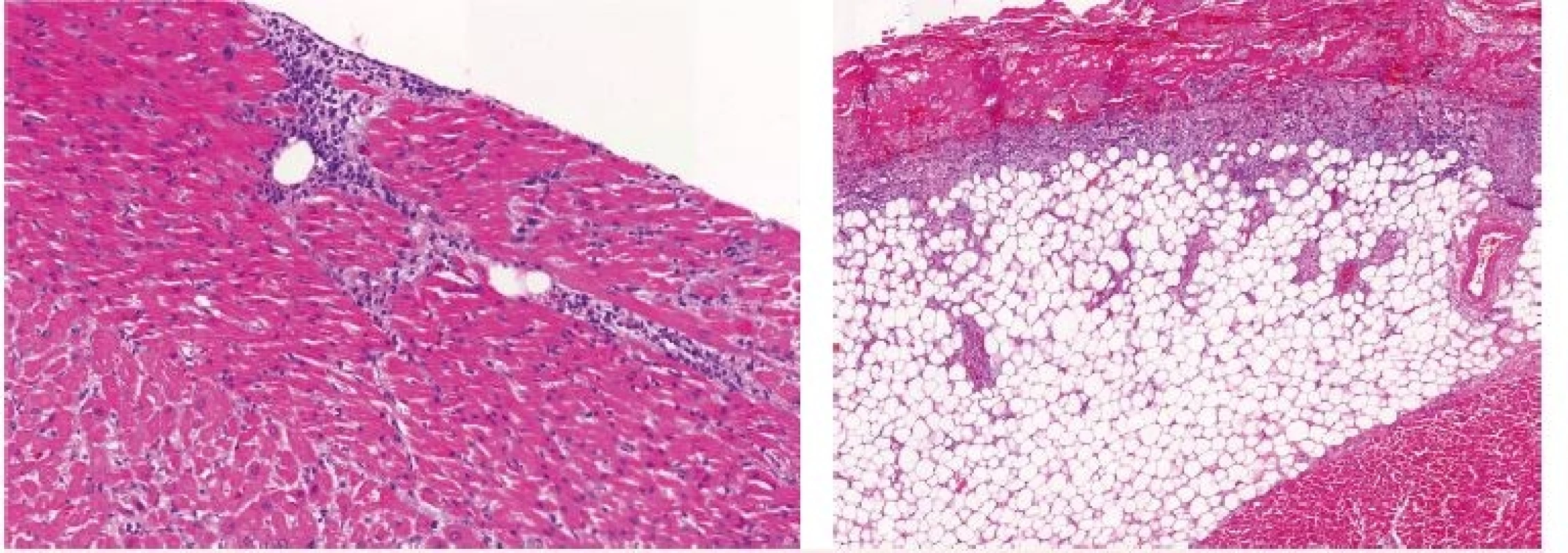 Kazuistika 2 – histologický obraz leukemické infiltrace orgánů
