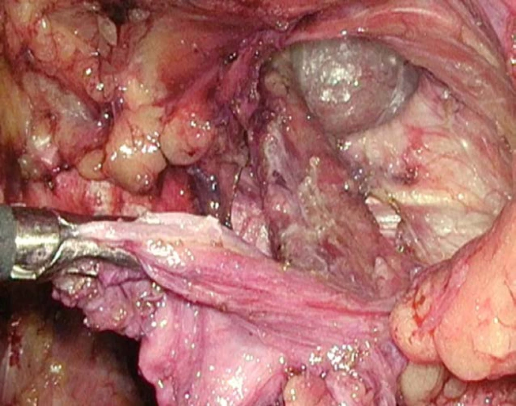 Vypreparovaný kýlní vak,
připraveno pro umístění síťky<br>
Fig. 1. An inguinal hernia sac,
prepared for mesh placement