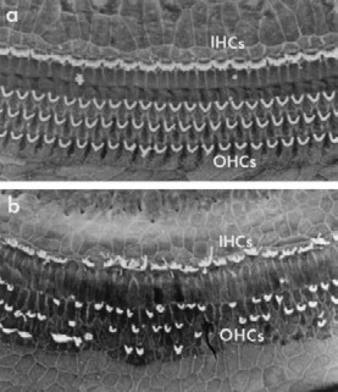 Poškození vnitřních i zevních vláskových buněk
v elektronovém mikroskopu (podle: Ryan et al., 10)
a – normální stav; b – poškozené vláskové buňky; IHCs –
vnitřní vláskové buňky; OHCs – zevní vláskové buňky.