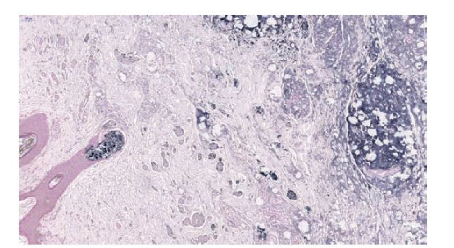 Histologie zmraženého řezu v barvení Sudanem, které barví černě
makrofágy obsahující kapénky parafínu (vpravo), myelinizované nervy
(uprostřed) a mazové žlázky (vlevo). 8.2x.