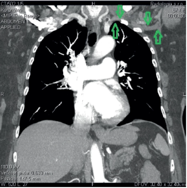 Occlusion (arrows) of the left subclavian artery of 7 cm of length at the site of the subclavian – vertebral artery bifurcation