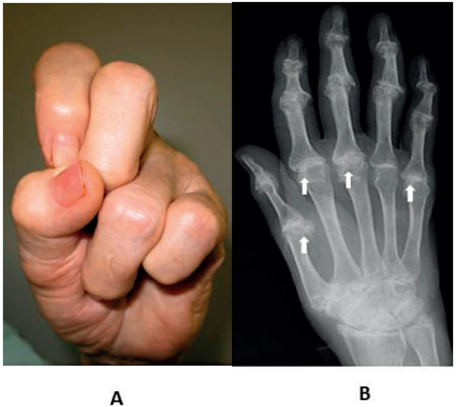 Artropatie MCP kloubů u hereditární hemochromatózy
(HH). Žena, 63 let s HH od 50 let a mimikry séronegativní (RF–,
ACPA–) revmatoidní artritidy a DMARD (disease modyfying antirheumatic drug) terapií v anamnéze: A – „železný pozdrav“
(archiv II. interní GE kliniky LF UK a FN, Hradec Králové – vlastní
pozorování), B – hákovité deformity na hlavičkách metakarpů
(šipky) (archiv Radiologické kliniky LF UK a FN Hradec Králové –
laskavostí MUDr. J. Brtkové)