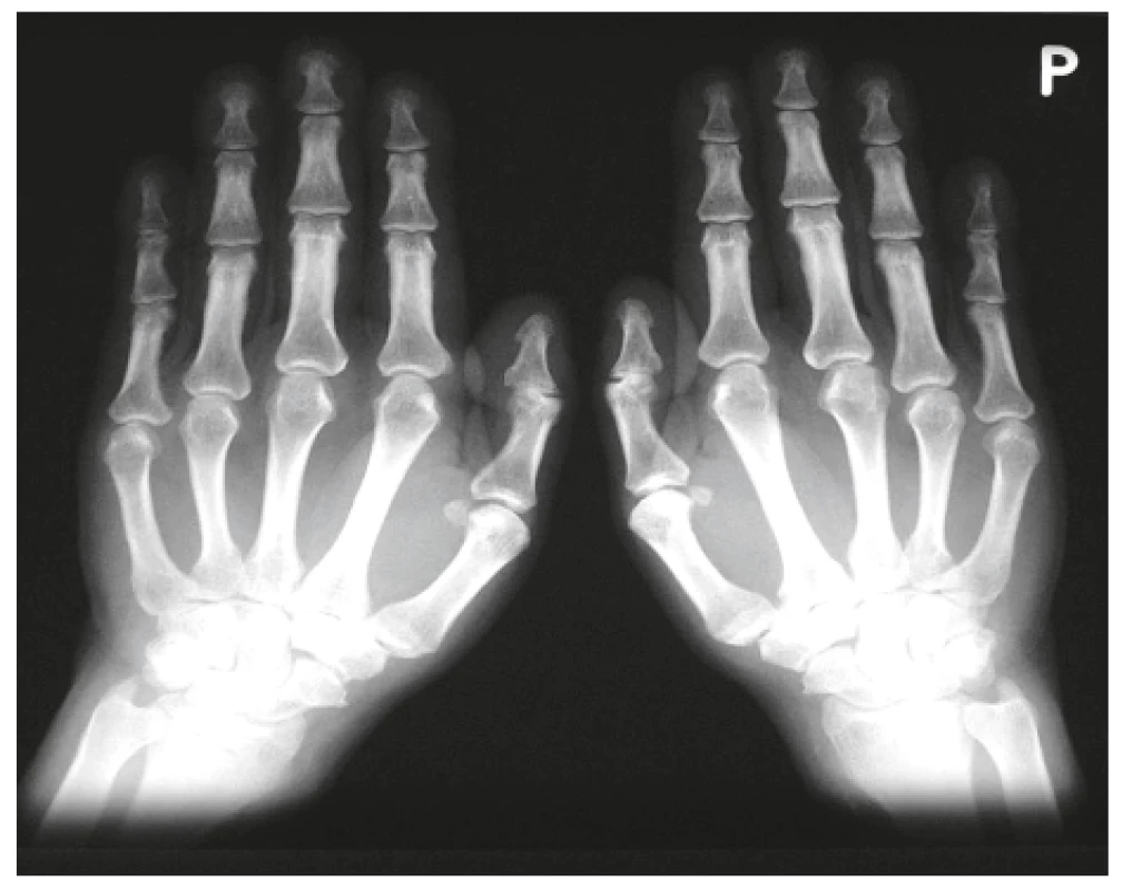 Akroosteolýza prstů u hypertrofické osteoartropatie