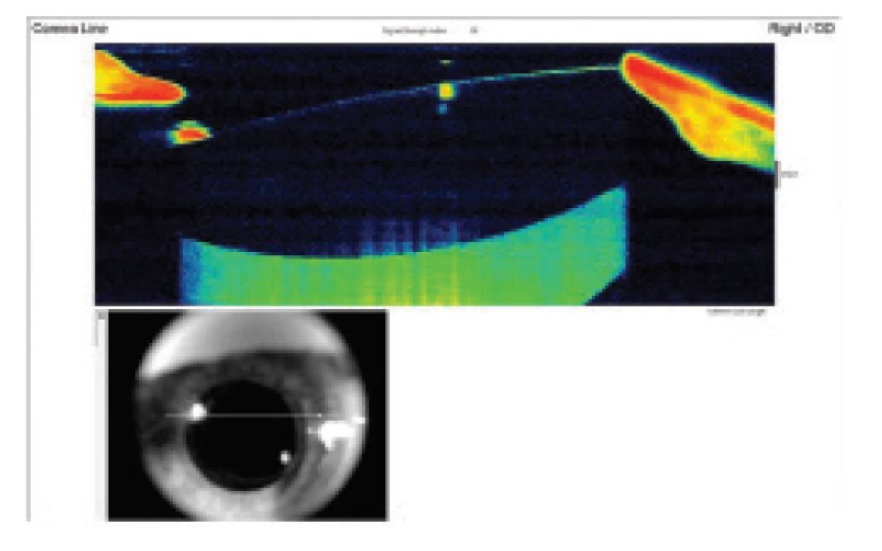 Anterior-segment OCT demonstrates capsular distension,
before lavage the posterior capsule is distended
backwards and filled with milky white fluid (hyperreflective
mass behind IOL). Well centred lens without front-to-
-back shifting.