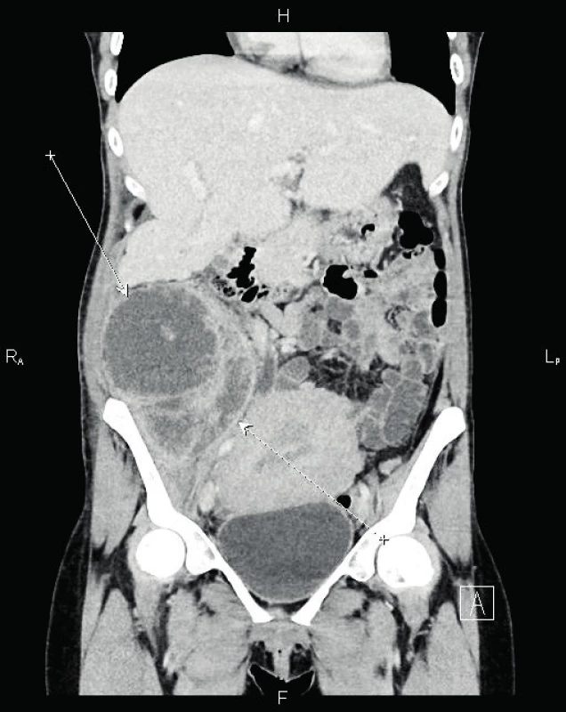 Sagitální řez retroperitoneálního abscesu