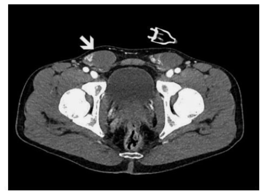 Postkontrastní CT vyšetření – axiální zobrazení
s nálezem dislokovaného varlete (šipka)<br>
Fig. 3. Initial CT scan – axial section showing the
dislocated testis (arrow)