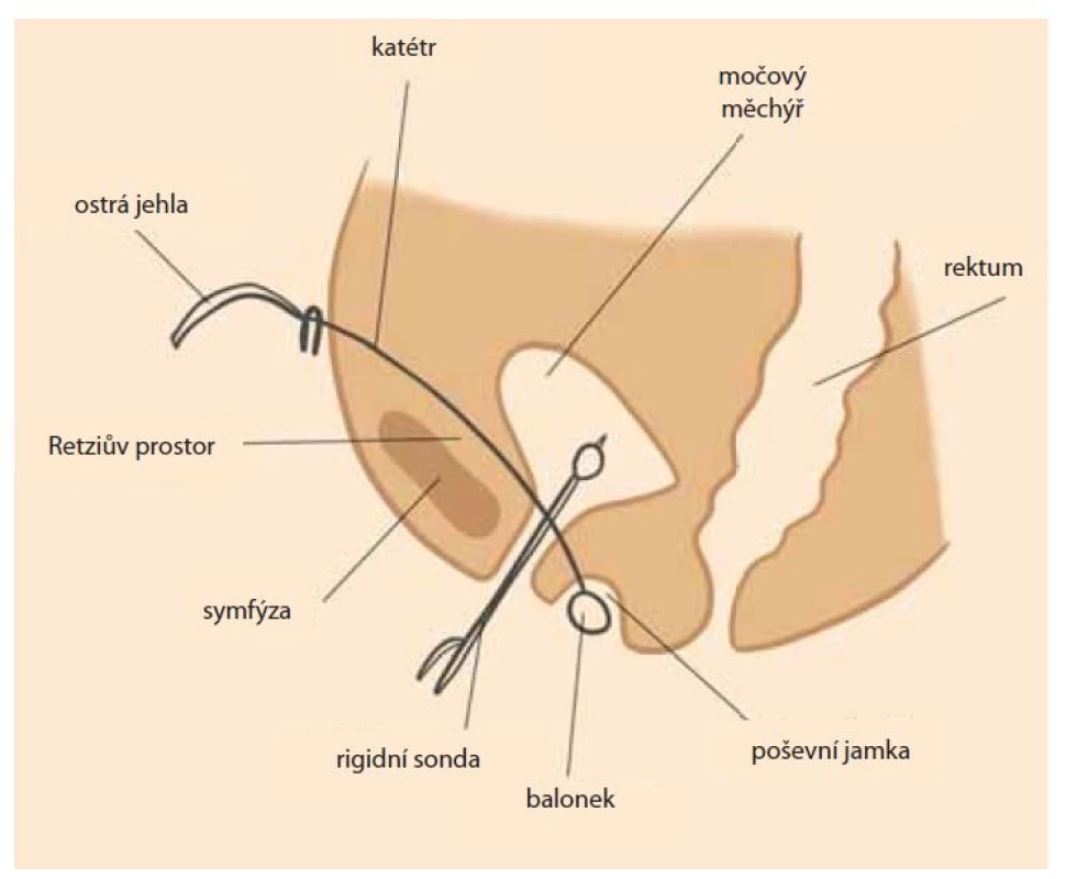 Retropubická balonková vaginoplastika.<br>
Fig. 2. Retropubic balloon vaginoplasty.