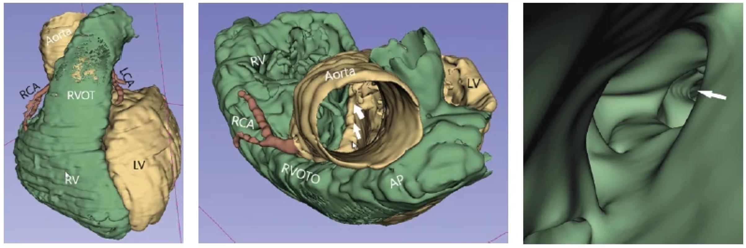 3D virtuálny „reálny“ model extra- aj intrakardiálnych štruktúr u 9-ročného pacienta klinicky sa manifestujúceho centrálnou cyanózou.
Išlo o pacienta s echokardiograficky diagnostikovanou Fallotovou tetralógiou. 3D model bol indikovaný na zobrazenie výtokového
traktu pravej komory (RVOT) a zobrazenie koronárnych artérií s cieľom vylúčenia priebehu ramus interventricularis anterior pred RVOT
(takýto nález kontraindikuje realizáciu transanulárnej záplaty cez pľúcnu chlopňu v rámci kompletnej chirurgickej korekcie chyby). Obrázok
vľavo: anteriórny pohľad. Zobrazené normálne odstupy a priebehy koronárnych artérií. Stredný obrázok: pohľad zhora. Cez ascendentnú
aortu pri pohľade nadol do srdca je vidieť hornú hranu medzikomorového septa (zobrazená bielymi šípkami), nad ktorou sa nachádza defekt
komorového septa, kedže pri pohľade z aorty je vidieť do oboch srdcových komôr. Zároveň sa vizualizuje užší výtokový trakt pravej komory
(RVOTO). Obrázok vpravo: detailný pohľad do stenotického RVOTO z pľúcnice (pohľad zhora nadol), v ktorom je vidieť početné svalové
trabekuly. Biela šípka ukazuje na vyústenie stenotického RVOTO smerom do pravej komory (RV). Na základe analýzy 3D modelu bola indikovaná
kompletná chirurgická korekcia pozostávajúca z uzáveru defeku komorového septa pomocou záplaty, z resekcie svalových trabekúl
v RVOT a z realizácie transanulárnej záplaty cez anulus pľúcnej chlopne s cieľom rozšírenia pľúcnice.