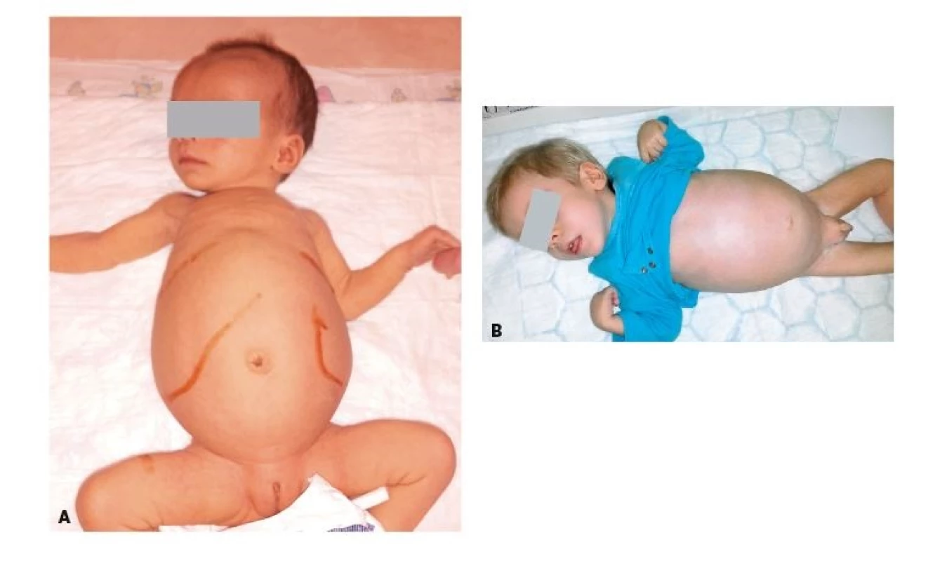 A. Objemná hepatosplenomegalie u 2měsíční dívky
s Niemannovou-Pickovou nemocí typu C.
B. Dystrofický 2letý chlapec s progredující hepatosplenomegalií
a jaterním selháním na podkladě
Niemannovy-Pickovy nemoci typu A/B.<br>
Fig 3. A. Extreme hepatosplenomegaly in 2-month-old child
with Niemann-Pick disease Type C.
B. Dystrophic 2-year-old boy with progressive hepatosplenomegaly
and liver failure based on Niemann-
-Pick disease Type A/B.