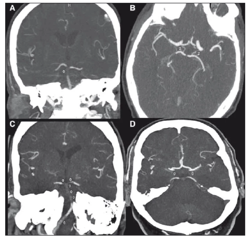 Pacient s Basilar Artery on Computed Tomography Angiography skóre = 9. (A) přítomna
distální okluze arteria basilaris; (B) jsou přítomny obě arteria communicans posterior.
Ve snímku označené „2“ (2 body). Pacient s Basilar Artery on Computed Tomography
Angiography skóre = 0. (C) rozsáhlá okluze arteria basilaris; (D) nepřítomnost obou arteria
communicans posterior [1].<br>
Fig. 2. Patient with Basilar Artery on Computed Tomography Angiography score = 9. (A)
distal occlusion of basilar artery; (B) both posterior communicating arteries are present.
Marked “2” in the image (2 points). Patient with Basilar Artery on Computed Tomography
Angiography score = 0. (C) extensive occlusion of basilar artery; (D) absence of both posterior
communicating arteries [1].