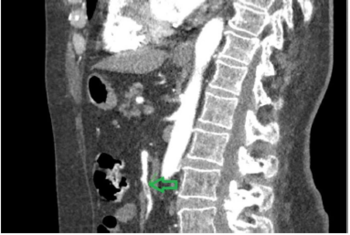 Partial occlusion (arrow) of superior mesenteric artery of 12 mm of length