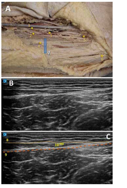 A: 1.–6. větve n. femoralis, 4. nervus femoralis cutaneus intermedialis,
7. poloha sondy. C: 8. povrchní fascie, 9. fascia lata, 10. NCFIM