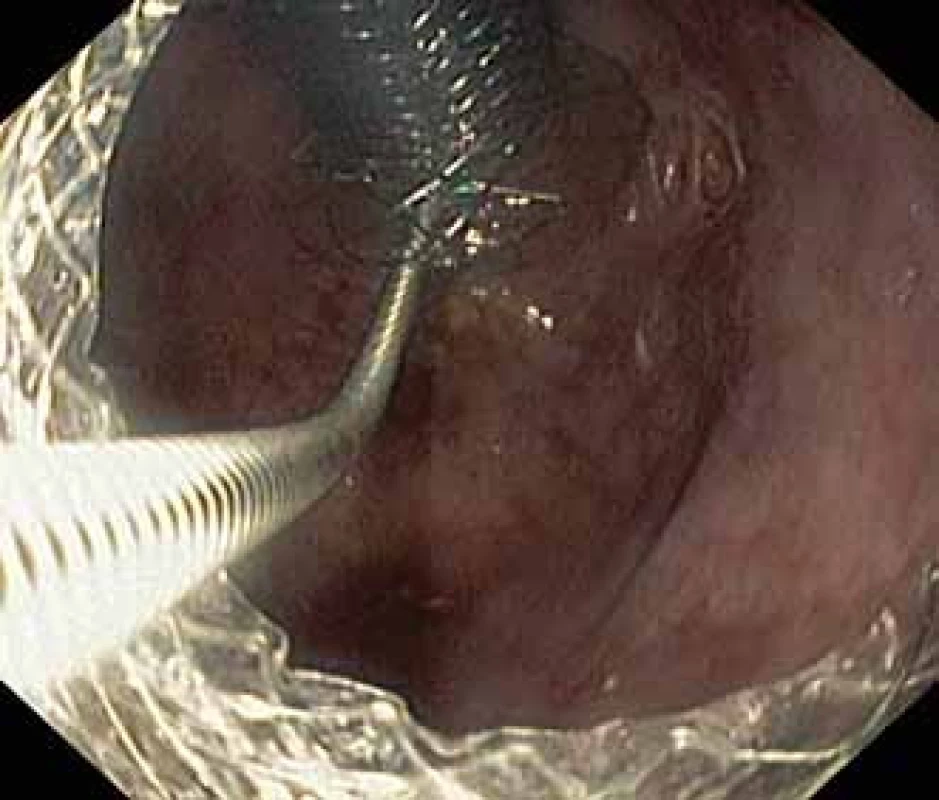 Extrakce Niti-S NAGI™ stentu pomocí kleští krysí zub.<br> Fig. 3. Extraction of the Niti-S NAGI™ stent using a rat-tooth forceps.