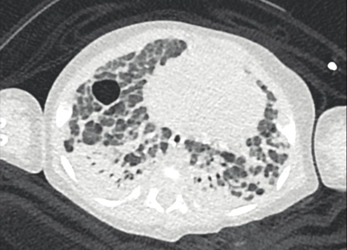 Počítačová tomografie plic u stejného chlapce s těžkými bulózními a emfyzematózními změnami při fibroproliferativní přestavbě plíce připomíná obraz „old“
BPD (archiv Radiodiagnostické kliniky 1. LF UK a VFN).<br>
Fig. 2. Chest computed tomography scan in the same boy with
severe bullous and emphysematous changes as a consequence of fibroproliferative lung remodelling resembles
the image of „old“ BPD (archive of the Department of
Radiology, First Faculty of Medicine, Charles University
and General University Hospital in Prague).