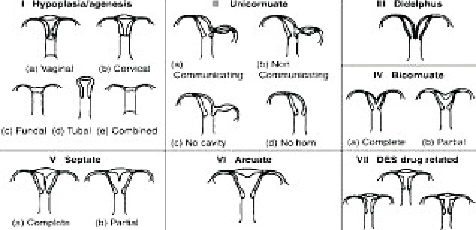 Klasifikace děložních malformací podle American Fertility Society (1988).
Fig. 1. Classification of congenital uterine anomalies as described by the American
Fertility society (1988).