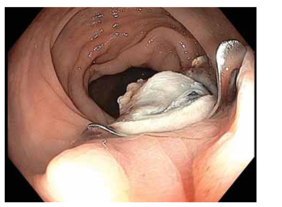 Spodina po FTR LRN z obr. 3, histologicky
R0 resekce tubulovilózního adenomu s těžkou dysplazií.<br>
Fig. 4. Bottom after FTR LRN of Fig. 3, histologically
R0 resection of tubulovillous adenoma with severe dysplasia.