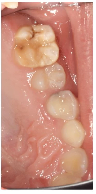 Hypomineralizovaný horní
molár s posteruptivní
frakturou<br>
Fig. 2
Hypominezalized upper
molar with posteruptive
fracture