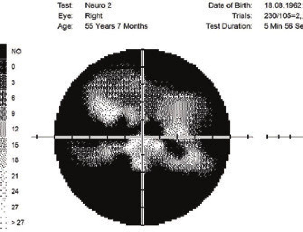 Changes of visual field upon anterior ischemic neuropathy
of the optics and GPA