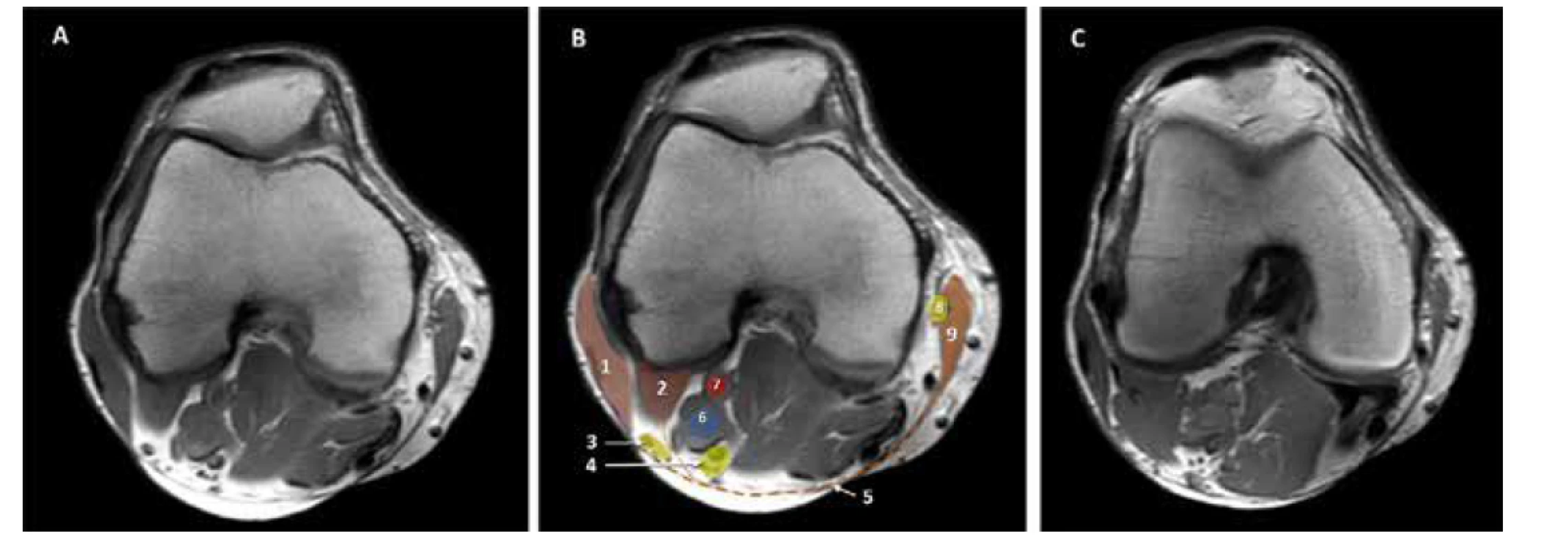 MRI kolena. A. nativní obraz. B. kolorovaný obraz: 1. m. biceps femoris, 2. zevní hlava m. gastrocnemius, 3. nervus peroneus communis, 4. n. tibialis,
5. hluboká fascie, 6. vena poplitea, 7. arterie poplitea. 8. n saphenus, 9. m sartorius. C. nativní obraz: horizontální řez 3 mm distálněji než A a B. Zevní hlava
m. gastrocnemius je mohutnější a zcela odděluje n. tibialis od n. peroneus