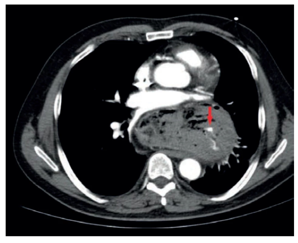 CT obraz aktivního krvácení ze žaludku herniovaného
do mediastina (upside-down stomach)<br>
Fig. 4. CT image of active bleeding from the stomach herniated
into the mediastinum (upside-down stomach)