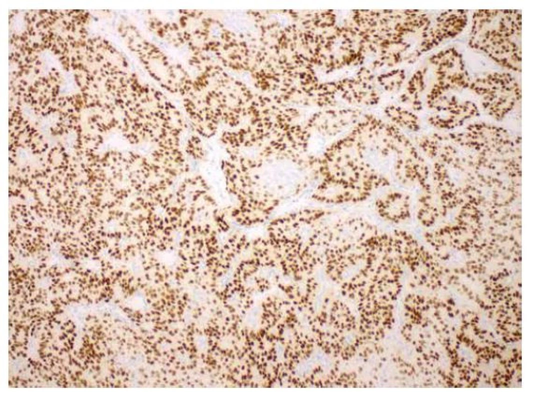 Kribriformní úprava nádorových struktur, imunohistochemicky
s průkazem silné exprese estrogenových receptorů (zvětšení 100x).