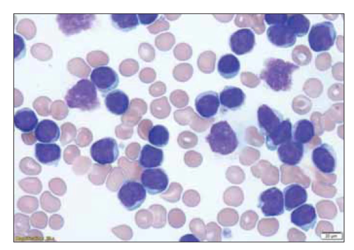 Erytrocyty a patologické lymfocyty v nátěru
periferní krve u pacienta s CLL (zdroj: laboratoř IV. IHK).<br>
CLL – chronická lymfocytární leukémie