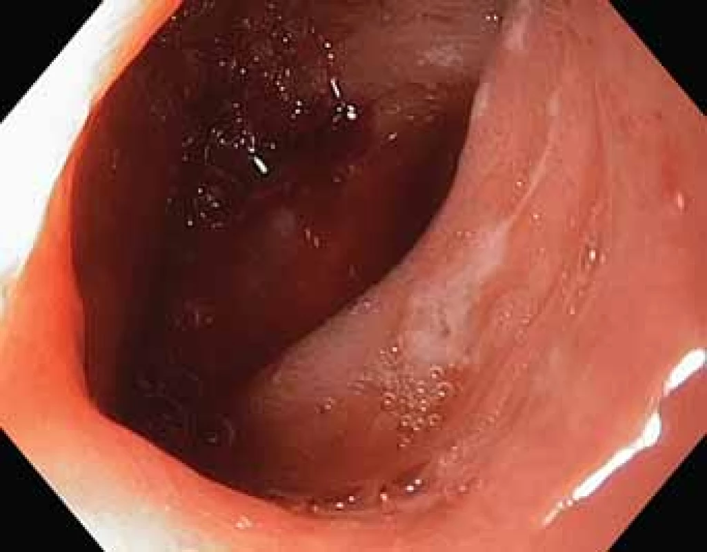Duodenal ulcer.<br>
Obr. 2. Vřed ve dvanáctníku.