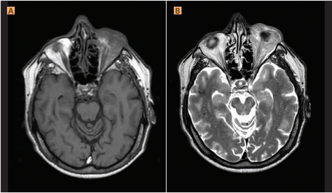 Pseudotumor: (A) nehomogenní hyposignální infiltrace levé orbity v T1WI a (B) nehomogenně hypersignální v T2WI, protruze levého bulbu