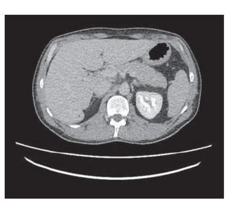 CT – hepatomegália, drobná
hypodenzná lézia do 3 mm v S6.<br>
Fig. 2. CT – hepatomegaly, small hypodense
lesion up to 3mm in S6.
