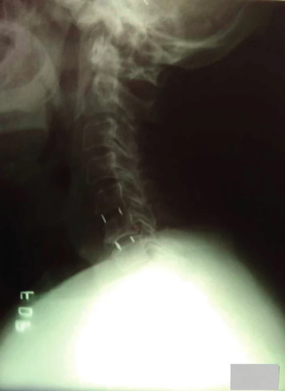 PEEK - náhrada krčnej medzistavcovej platničky. Na
snímku sú viditeľné drôtené markery, podľa ktorých sa posudzuje
správne zavedenie implantátu.